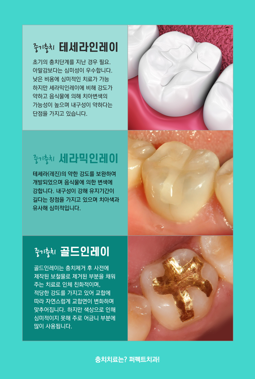 세라믹 인레이 충치치료 비용 관련 이미지 3