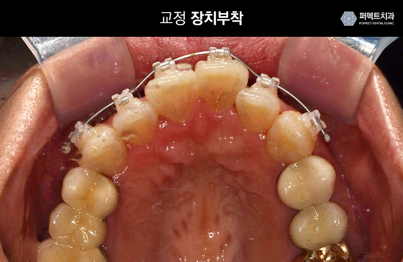 클리피시교정 기간과 비용 관련 이미지 4