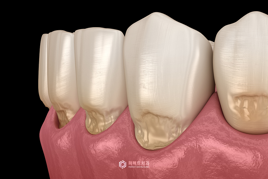 치아가 시린 이유, 치경부마모증?! 관련 이미지 2
