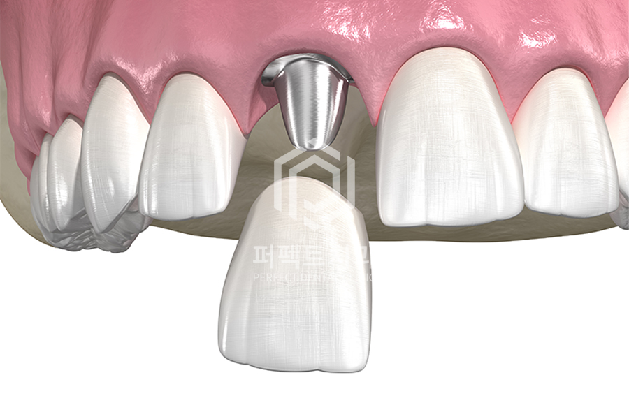 임플란트 뼈이식 베스트 질문 시리즈① 관련 이미지 1