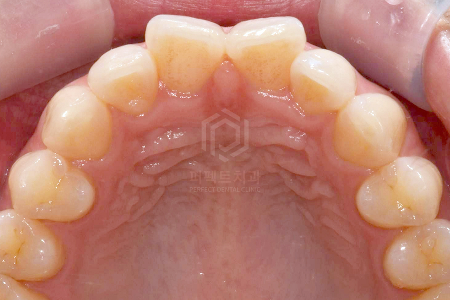 나비치아 치료방법①|부분교정편 관련 이미지 3