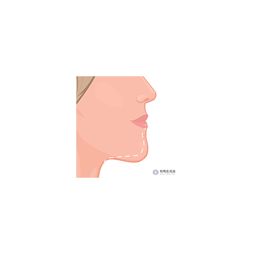 비수술 주걱턱 교정 결과 관련 이미지 6