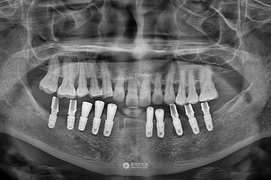 윗니 전체 신경치료 했다고?😱 교합평면이 뭐길래 관련 이미지 5