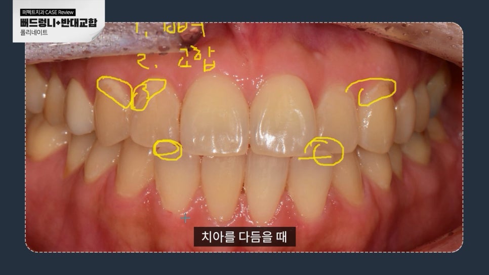 앞니 폴리네이트+치아미백 치료 관련 이미지 5