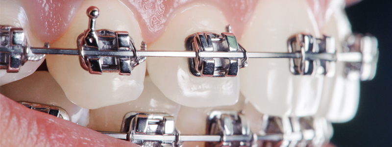 치아교정 기간 왜 다를까? 관련 이미지 2