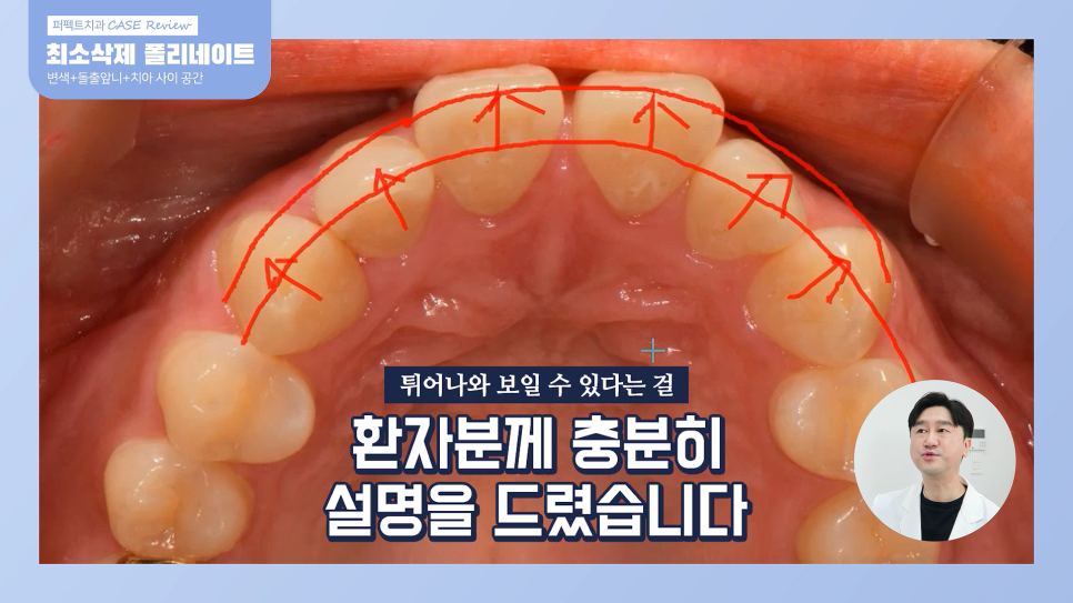 앞니 돌출,벌어짐,변색.. 교정이 싫다면 이 방법으로!? 관련 이미지 6