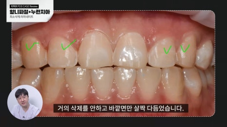 깨진 앞니 치료, 라미네이트로! 관련 이미지 6