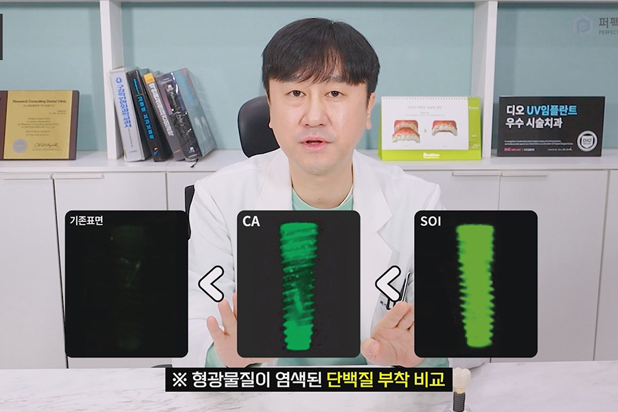 치료 기간을 단축 시킬 수 있는 임플란트의 종류는? 관련 이미지 2