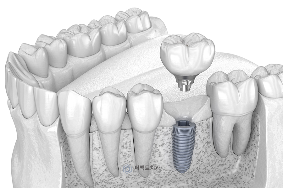 임플란트 후 임시치아, 임시틀니② 관련 이미지 1