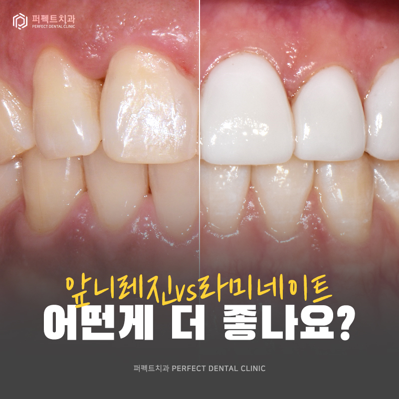 앞니 레진vs앞니 라미네이트 어떤게 더 좋을까요? 관련 이미지 1