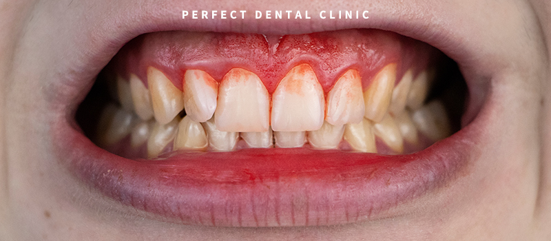 잇몸에 염증 종류와 치과치료 관련 이미지 3