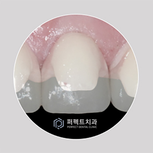 강남치과 무삭제라미네이트비용 관련 이미지 2