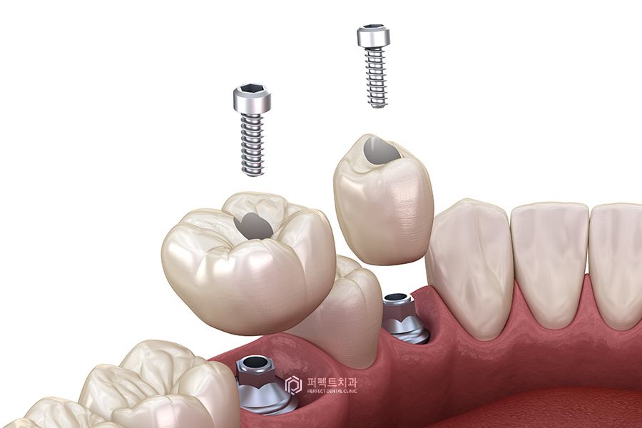 임플란트 보철 탈락②｜크라운이 빠지는 이유, 두 번째 관련 이미지 3
