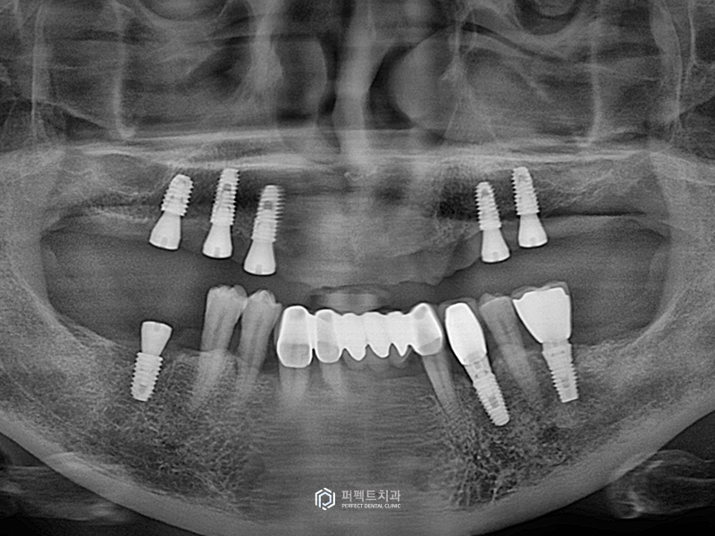 네비게이션 가이드로 전악임플란트를 20분만에? 관련 이미지 5