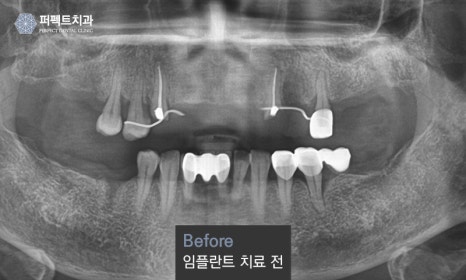 노인 임플란트 건강보험 혜택은? 관련 이미지 1