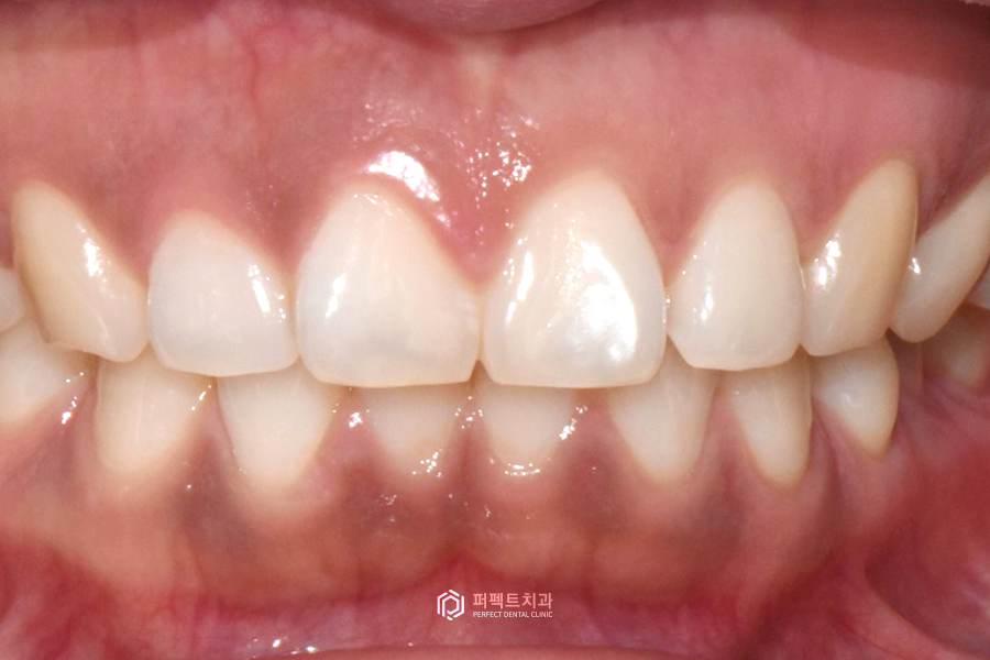 나비치아, 부분교정vs라미네이트 치과의사가 추천하는 방법은? 관련 이미지 7