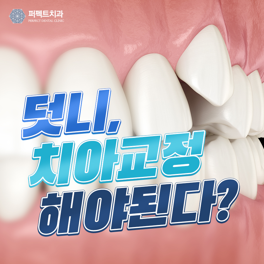 덧니, 교정이 필요하다? 덧니교정의 모든 것! 관련 이미지 1