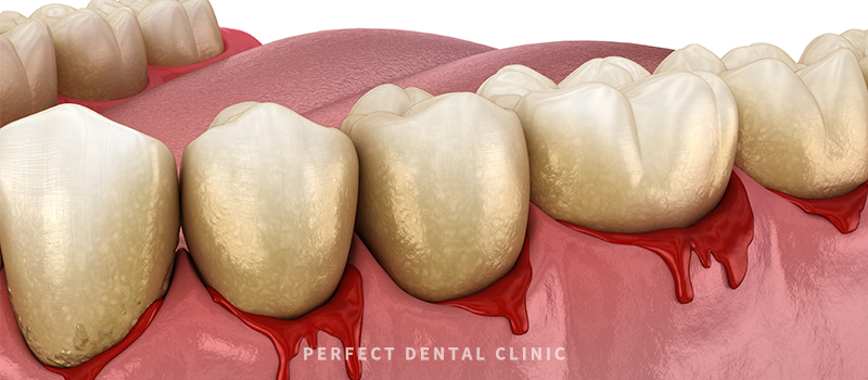 잇몸염증 증상과 좋은 음식 관련 이미지 3