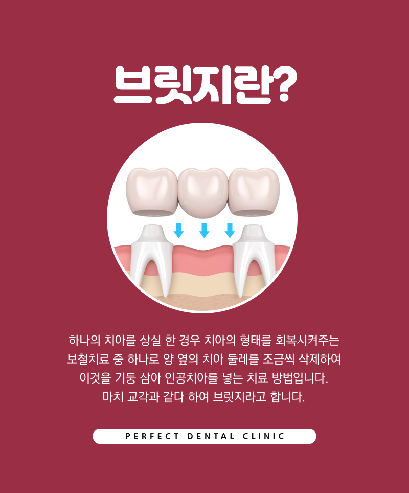 치아상실했을때 브릿지로? 관련 이미지 2