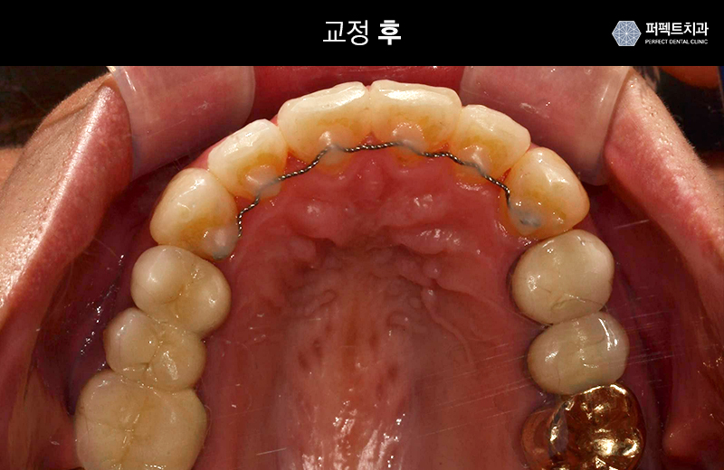 클리피시교정 기간과 비용 관련 이미지 5