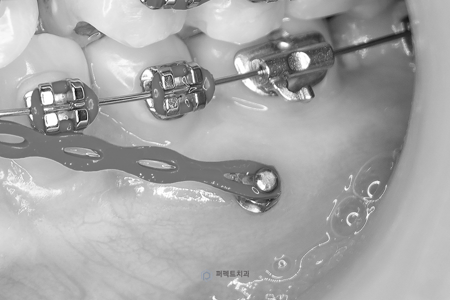 치아교정 미니스크류|꼭 심어야되나요?, 통증은? 관련 이미지 4