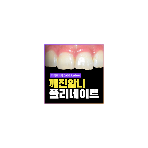 깨진 앞니 라미네이트 치료 CASE! 관련 이미지 5