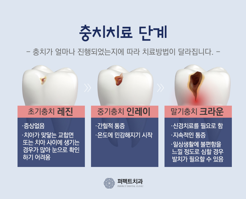 선릉 충치치료 인레이 알아보기! 관련 이미지 5