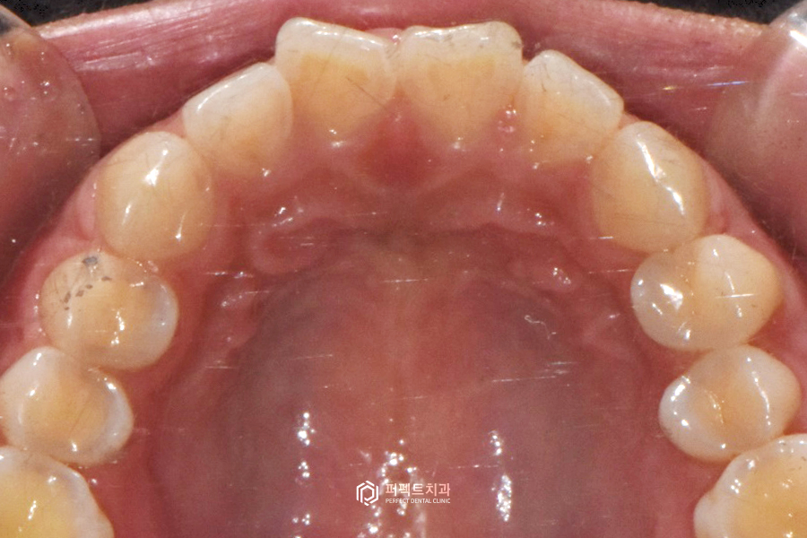 나비치아, 부분교정vs라미네이트 치과의사가 추천하는 방법은? 관련 이미지 6