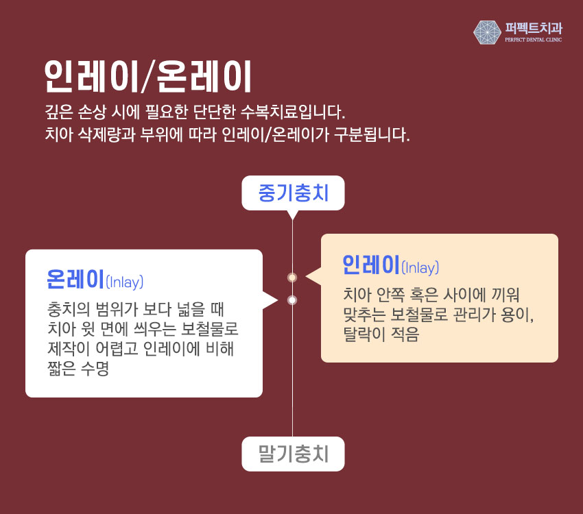 세라믹인레이 충치치료 비용 관련 이미지 5