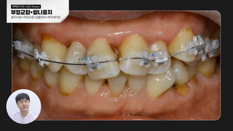 [부정교합+충치] 복합적인 문제를 가진 치아, 치료결과는? 관련 이미지 5