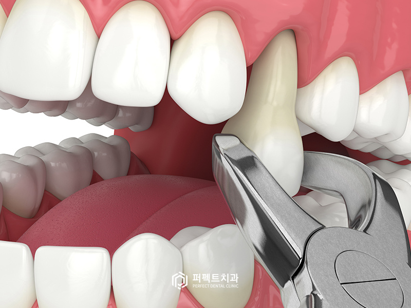 돌출입 교정 시 입을 얼마나 넣을 수 있을까? 관련 이미지 3