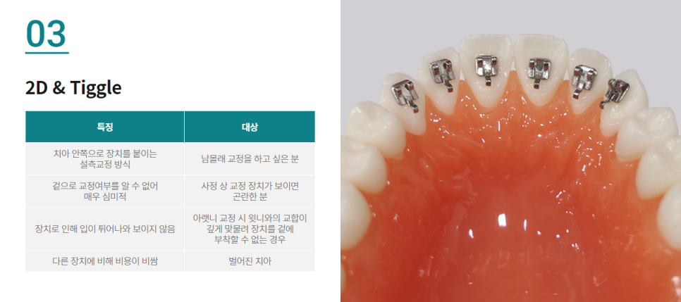 벌어진앞니교정, 원인부터 해결 방법까지 관련 이미지 7