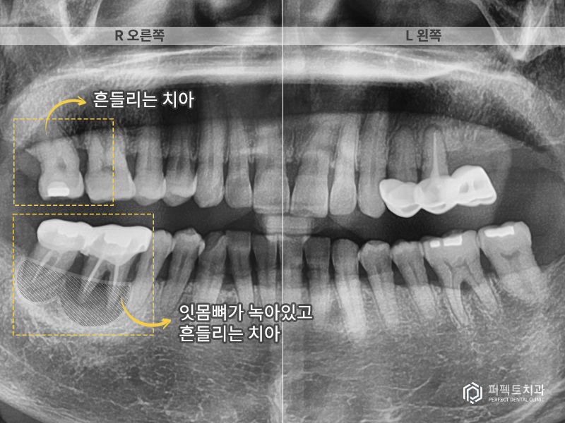 장거리+다수의 임플란트 케이스 관련 이미지 2