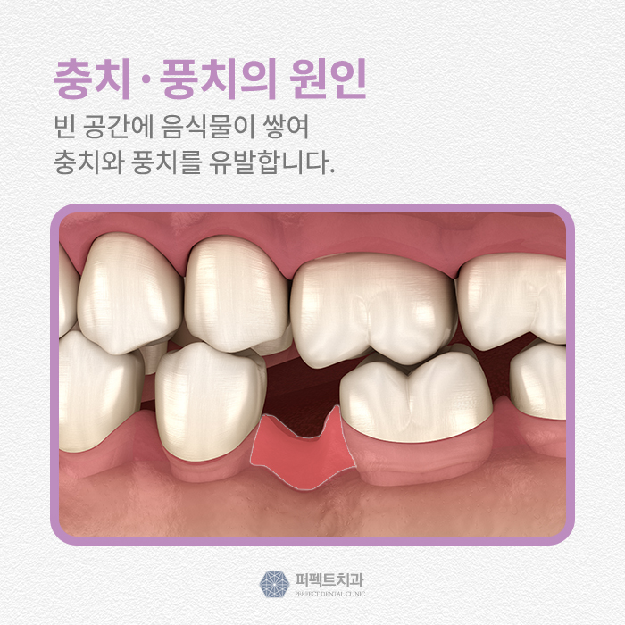 빠진 치아를 그대로 방치한다면? 관련 이미지 4