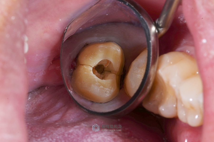 ✨신경치료 질문 BEST② 관련 이미지 3