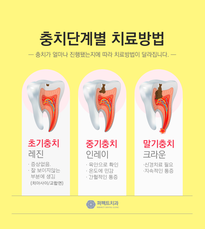 부담없는 충치치료가격 충치DAY로~&hearts; 관련 이미지 4