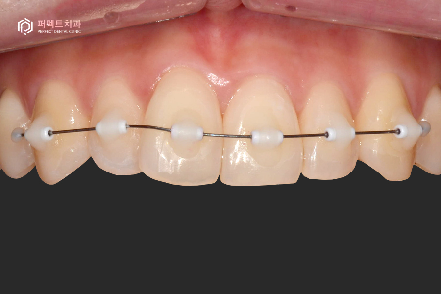 삐뚤거리는 아랫니를 6개월만에 반듯하게?! 관련 이미지 4