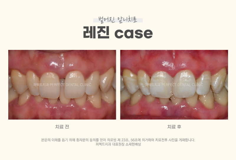 벌어진 앞니를 치료하는 다양한 방법 관련 이미지 4
