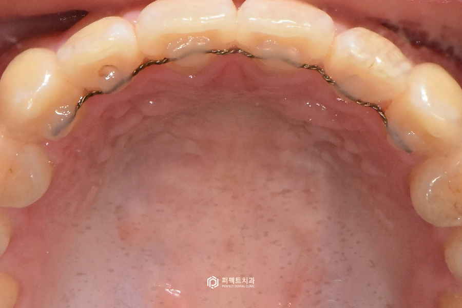 치료해도 자꾸 벌어지는 치아..😨 원인은? 관련 이미지 10