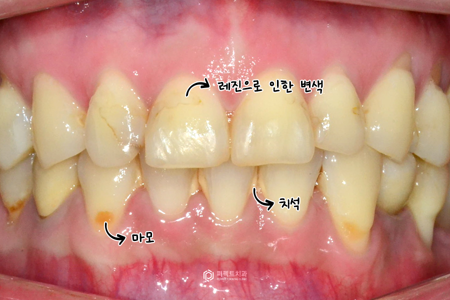 레진으로 변색+마모된 치아, 개선 방법은? 관련 이미지 2