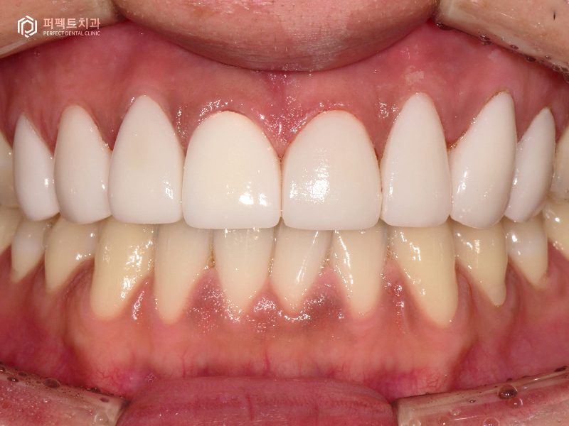 남자라미네이트, 폴리네이트 두가지 케이스 관련 이미지 11