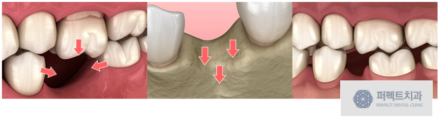 빠진치아 자리에? 임플란트 수술로! 관련 이미지 2