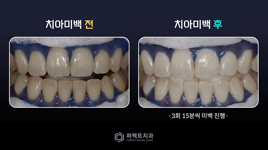 직접 받아본✨치아미백 과정② 관련 이미지 1