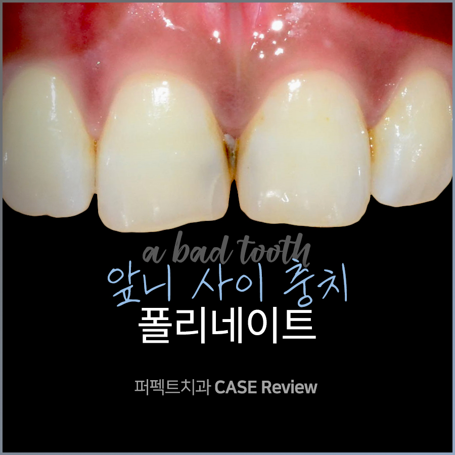 앞니 사이 충치, 어떻게 치료해야 티 안 날까? 관련 이미지 1