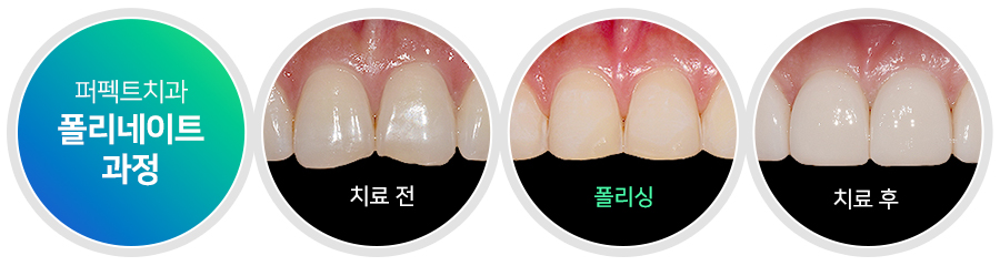 라미네이트 치료 시 참고사항은? 관련 이미지 5