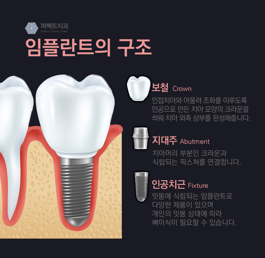 임플란트 재수술, 도대체 무엇이 잘못되었길래 관련 이미지 2