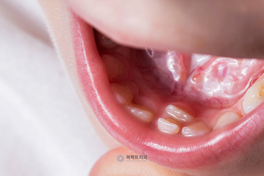 소아 치과치료①｜소아과잉치란? 관련 이미지 2