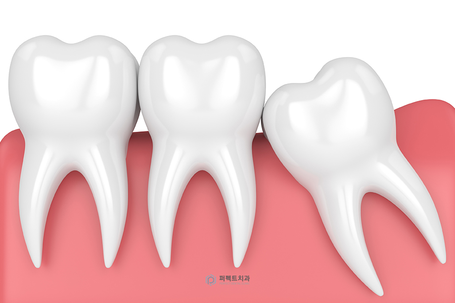임플란트 관리｜임플란트 후 음식물이 끼는 이유는 관련 이미지 2