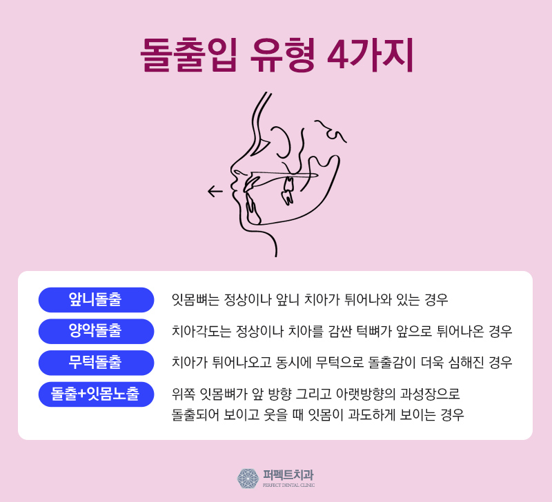돌출입교정 비용 관련 이미지 2