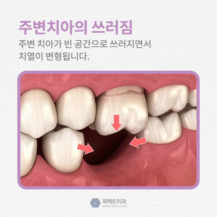 빠진 치아를 그대로 방치한다면? 관련 이미지 2
